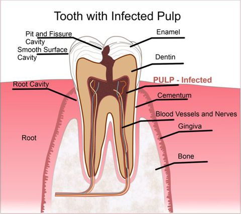 Tooth with Infected Pulp